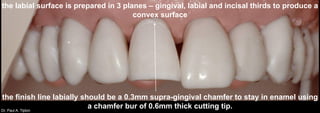 Dr. Paul A. Tipton
the labial surface is prepared in 3 planes – gingival, labial and incisal thirds to produce a
convex surface
the finish line labially should be a 0.3mm supra-gingival chamfer to stay in enamel using
a chamfer bur of 0.6mm thick cutting tip.
 