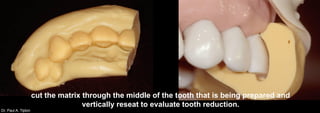 Dr. Paul A. Tipton
cut the matrix through the middle of the tooth that is being prepared and
vertically reseat to evaluate tooth reduction.
 