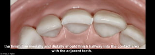 Dr. Paul A. Tipton
the finish line mesially and distally should finish halfway into the contact area
with the adjacent teeth.
 