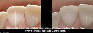 Dr. Paul A. Tipton
place depth cut on the palatal incisal edge and prepare palatal chamfer 1mm
over the incisal edge and 0.5mm depth.
 