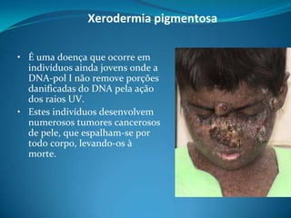Xerodermia pigmentosa
• É uma doença que ocorre em
indivíduos ainda jovens onde a
DNA-pol I não remove porções
danificadas do DNA pela ação
dos raios UV.
• Estes indivíduos desenvolvem
numerosos tumores cancerosos
de pele, que espalham-se por
todo corpo, levando-os à
morte.

 