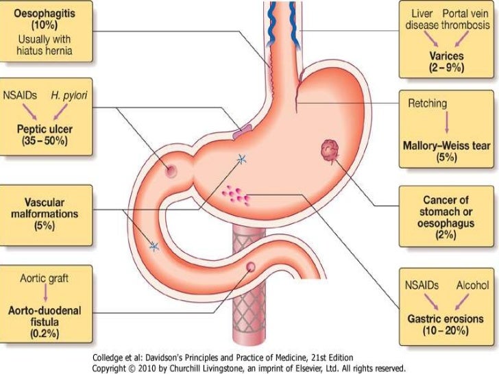 Aetiology of upper gi bleed