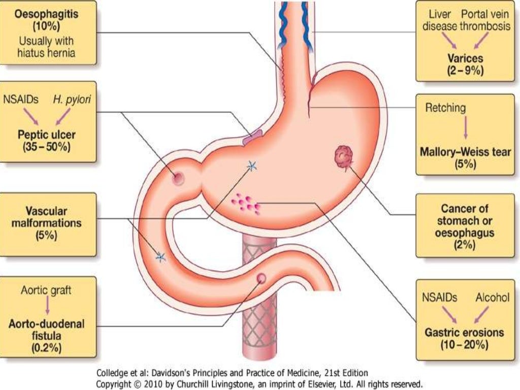 Aetiology Of Upper Gi Bleed aetiology-of-upper-gi-bleed