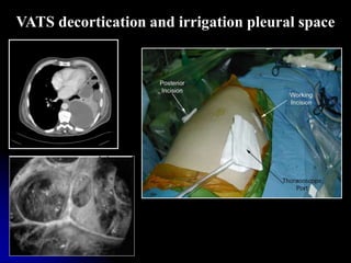 Aetiopathogenesis and management of empyema thoracis | PPTX
