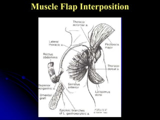Interposition Flap Aetiopathogenesis and management of empyema thoracis | PPTX