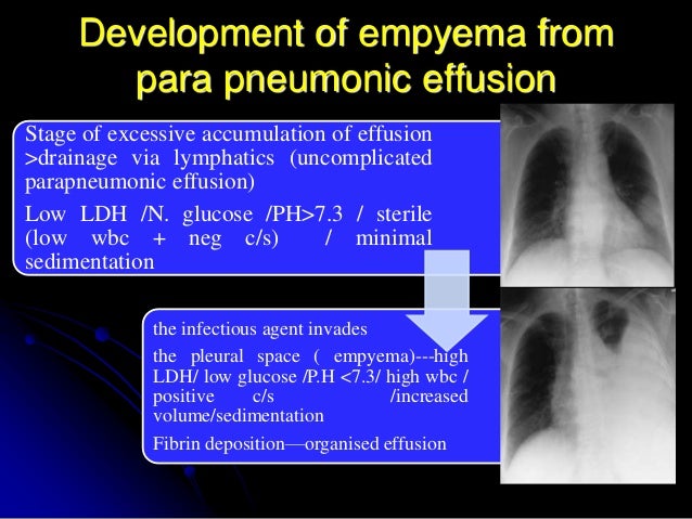 Aetiopathogenesis and management of empyema thoracis