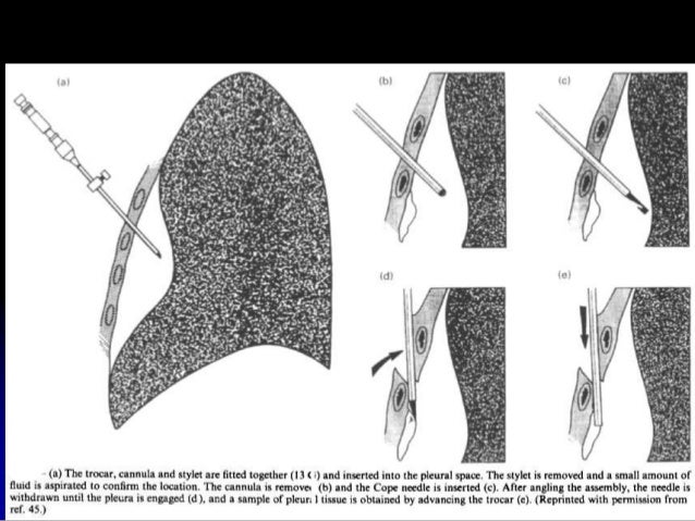 Clagett Procedure _ Management of Intrathoracic Defects – CWPI