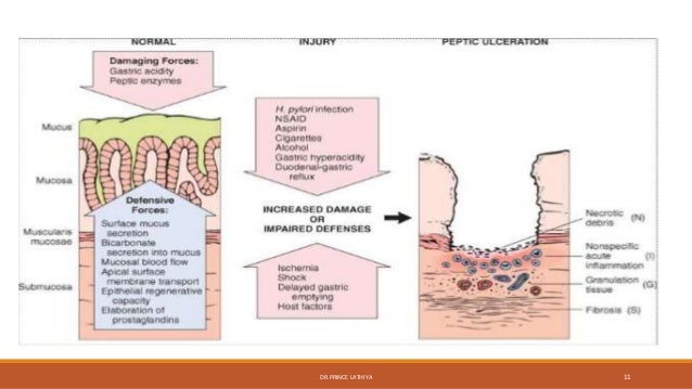 Aetiopathophysiology of peptic ulcer diesese