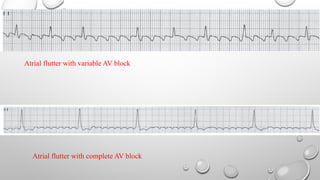 Atrial fibrillation & atrial flutter.pptx