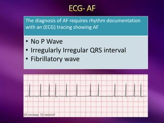 The diagnosis of AF requires rhythm documentation
with an (ECG) tracing showing AF
• No P Wave
• Irregularly Irregular QRS interval
• Fibrillatory wave
 