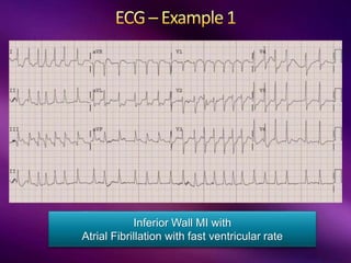 Inferior Wall MI with
Atrial Fibrillation with fast ventricular rate
 