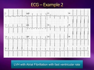 LVH with Atrial Fibrillation with fast ventricular rate
 