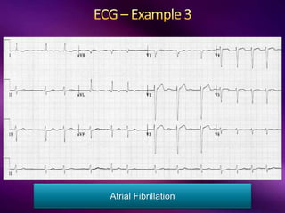 Atrial Fibrillation
 