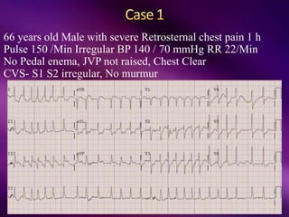 66 years old Male with severe Retrosternal chest pain 1 h
Pulse 150 /Min Irregular BP 140 / 70 mmHg RR 22/Min
No Pedal enema, JVP not raised, Chest Clear
CVS- S1 S2 irregular, No murmur
 