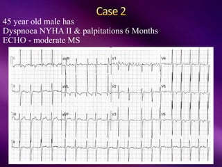 45 year old male has
Dyspnoea NYHA II & palpitations 6 Months
ECHO - moderate MS
 