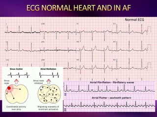 LEFT ATRIA
Normal ECG
 