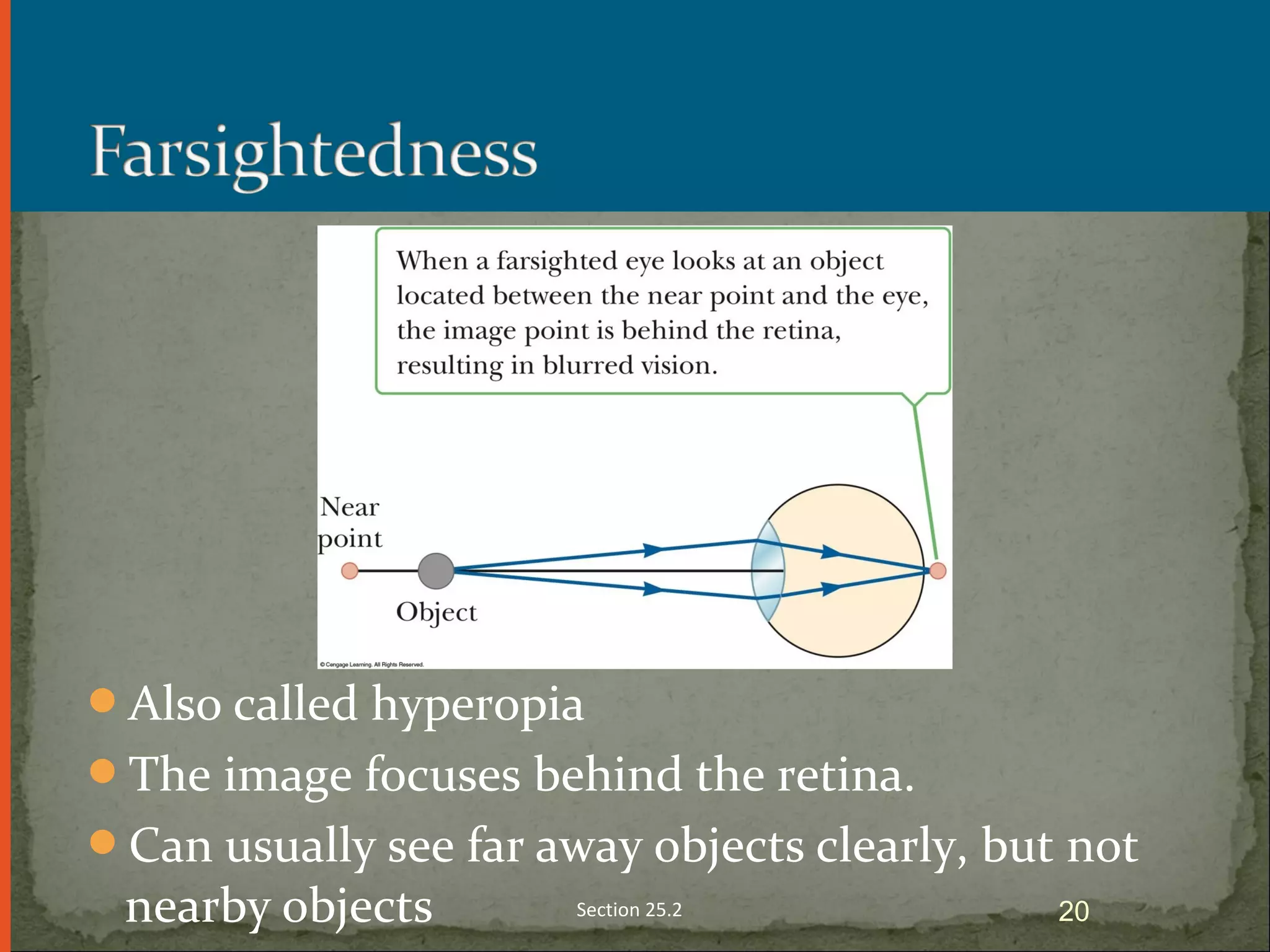 Also called hyperopia
The image focuses behind the retina.
Can usually see far away objects clearly, but not
nearby objects Section 25.2 20
 