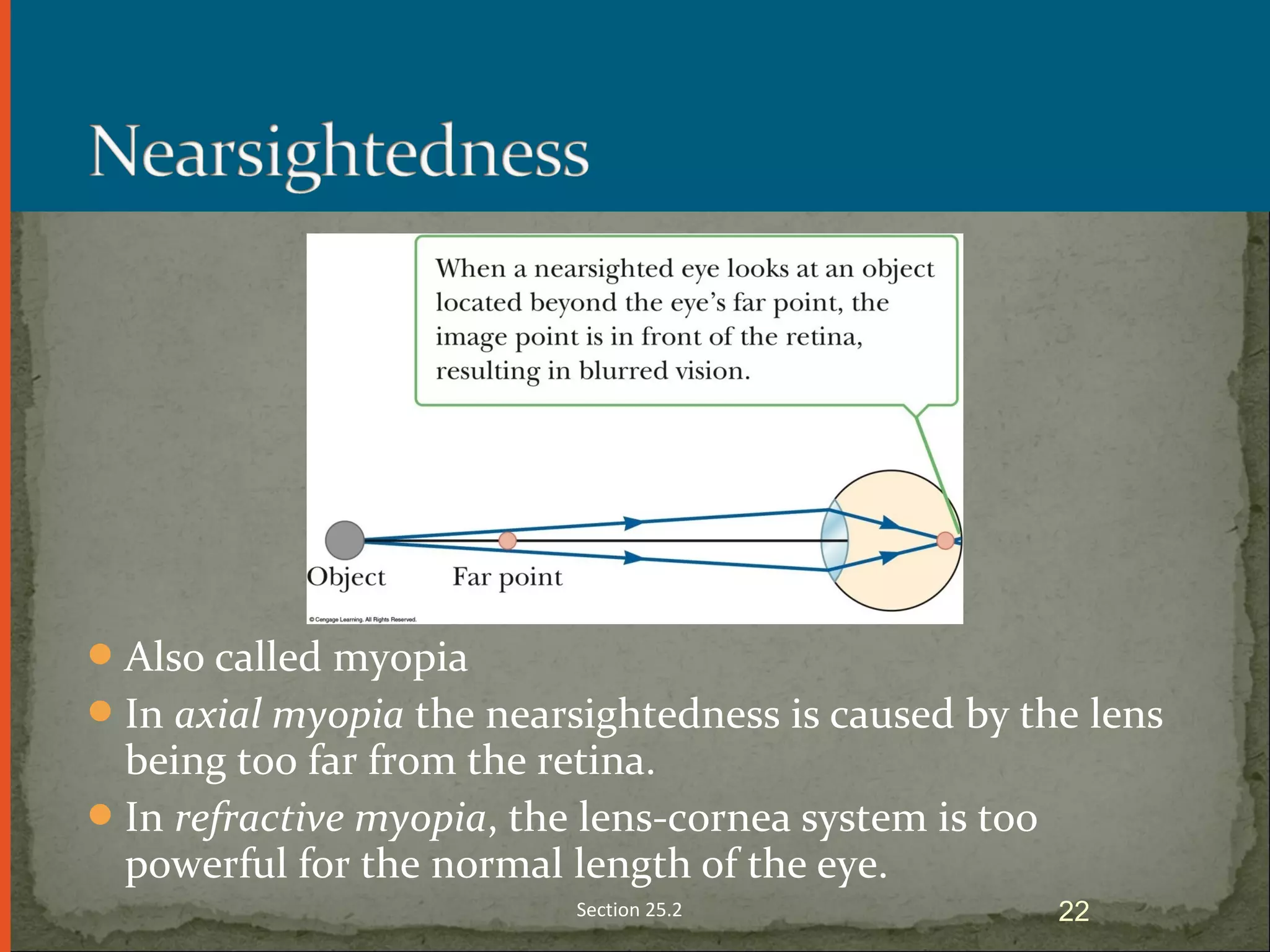 Also called myopia
In axial myopia the nearsightedness is caused by the lens
being too far from the retina.
In refractive myopia, the lens-cornea system is too
powerful for the normal length of the eye.
Section 25.2 22
 