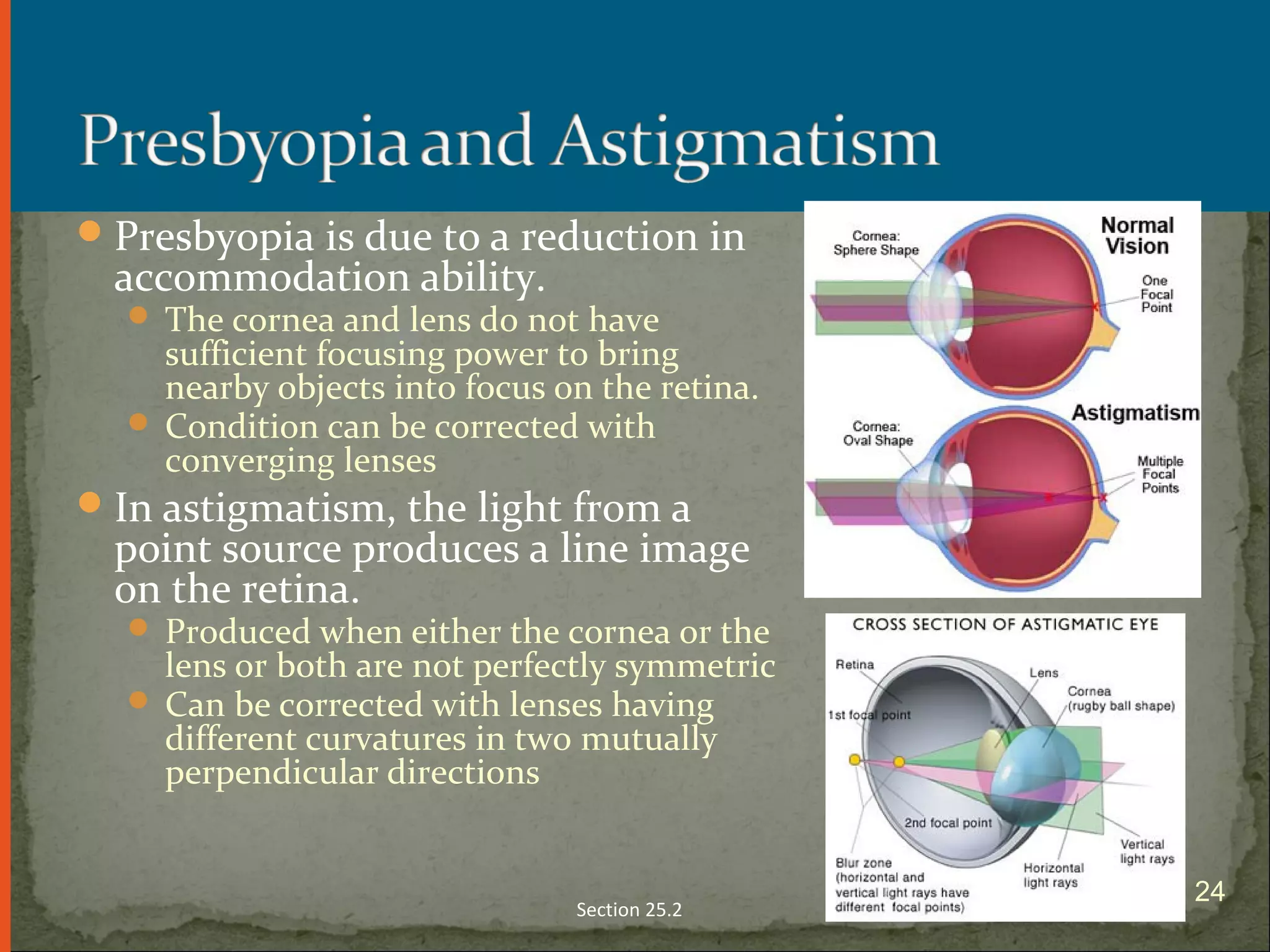 Presbyopia is due to a reduction in
accommodation ability.
 The cornea and lens do not have
sufficient focusing power to bring
nearby objects into focus on the retina.
 Condition can be corrected with
converging lenses
In astigmatism, the light from a
point source produces a line image
on the retina.
 Produced when either the cornea or the
lens or both are not perfectly symmetric
 Can be corrected with lenses having
different curvatures in two mutually
perpendicular directions
Section 25.2
24
 