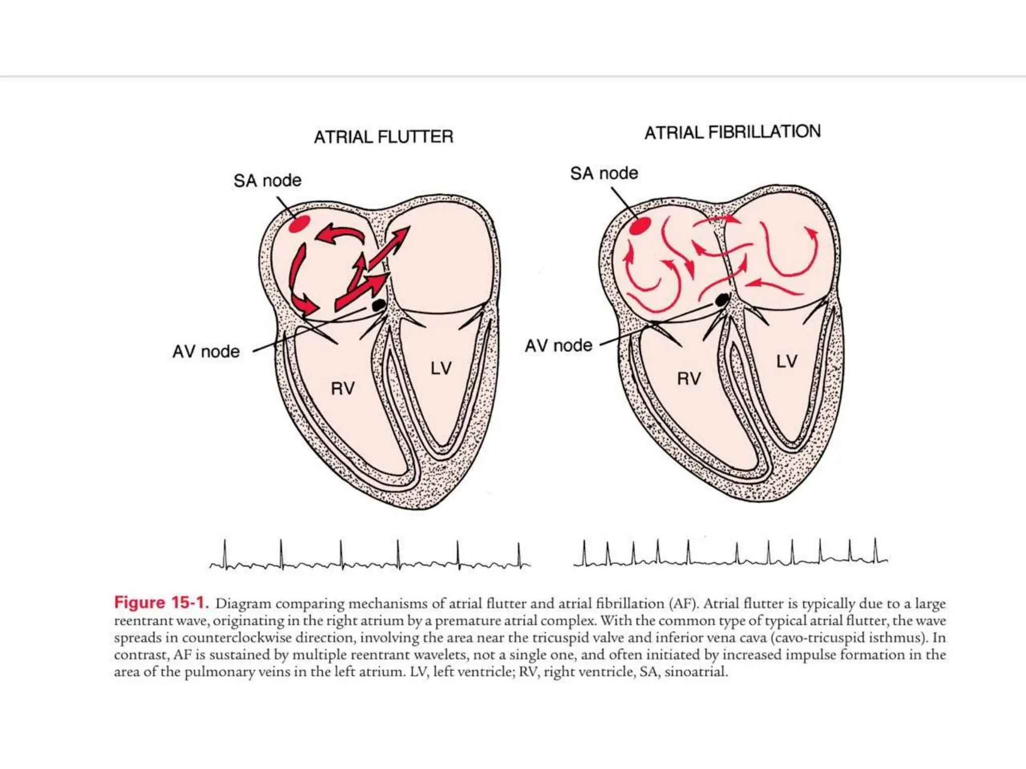 atrial fib and atrial flutter .pptx