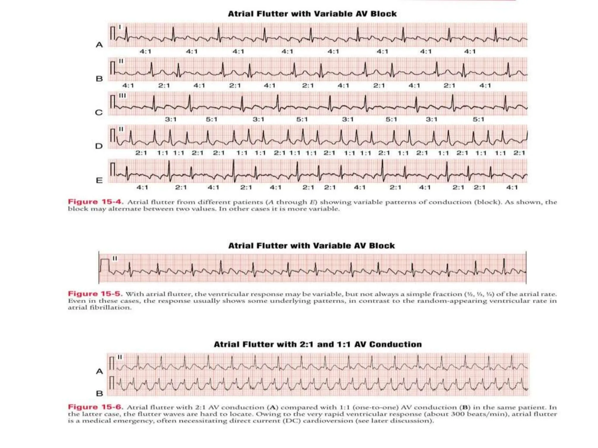 atrial fib and atrial flutter .pptx