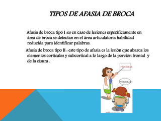 TIPOS DE AFASIA DE BROCA
Afasia de broca tipo I :es en caso de lesiones específicamente en
área de broca se detectan en el área articulatoria habilidad
reducida para identificar palabras.
Afasia de broca tipo II : este tipo de afasia es la lesión que abarca los
elementos corticales y subcortical a lo largo de la porción frontal y
de la cisura .
 