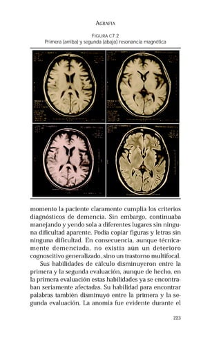 223 
AGRAFIA 
FIGURA C7.2 
Primera (arriba) y segunda (abajo) resonancia magnética 
momento la paciente claramente cumplía los criterios 
diagnósticos de demencia. Sin embargo, continuaba 
manejando y yendo sola a diferentes lugares sin ningu-na 
dificultad aparente. Podía copiar figuras y letras sin 
ninguna dificultad. En consecuencia, aunque técnica-mente 
demenciada, no existía aún un deterioro 
cognoscitivo generalizado, sino un trastorno multifocal. 
Sus habilidades de cálculo disminuyeron entre la 
primera y la segunda evaluación, aunque de hecho, en 
la primera evaluación estas habilidades ya se encontra-ban 
seriamente afectadas. Su habilidad para encontrar 
palabras también disminuyó entre la primera y la se-gunda 
evaluación. La anomia fue evidente durante el 
 