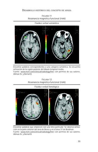 33 
DESARROLLO HISTÓRICO DEL CONCEPTO DE AFASIA 
FIGURA 11 
Resonancia magnética funcional (FMRI) 
Fluidez verbal semántica 
Encontrar palabras correspondientes a una categoría semántica. Se encuentra 
activación de la región posteior del lóbulo temporal medio. 
Fuente: www.mch.com/clinical/radiology/fmri con permiso de sus autores, 
Altman N. y Bernal B. 
FIGURA 12 
Resonancia magnética funcional (FMRI) 
Fluidez verbal fonológica 
Encontrar palabras que empiecen con una letra particular. Se observa activa-ción 
en la parte anterior del área de Broca y en el área 37 de Brodman. 
Fuente: www.mch.com/clinical/radiology/fmri con permiso de sus autores, 
Altman N. y Bernal B. 
 