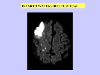 INFARTO WATERSHED CORTICAL 