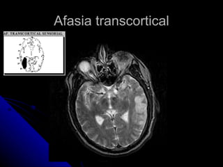Afasia transcortical 