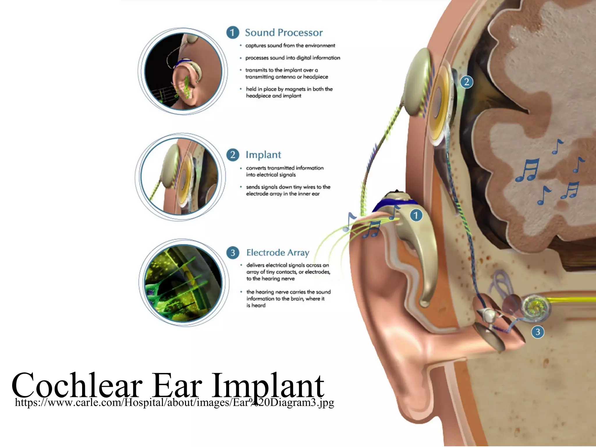 https://www.carle.com/Hospital/about/images/Ear%20Diagram3.jpg
Cochlear Ear Implant
 