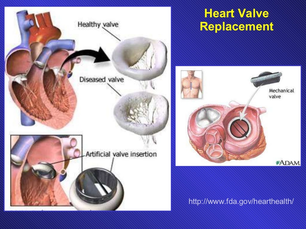 overview on cardioplegia by Dr. Idit Avrahami