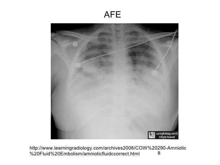 dic amniotic fluid embolism dic amniotic fluid embolism