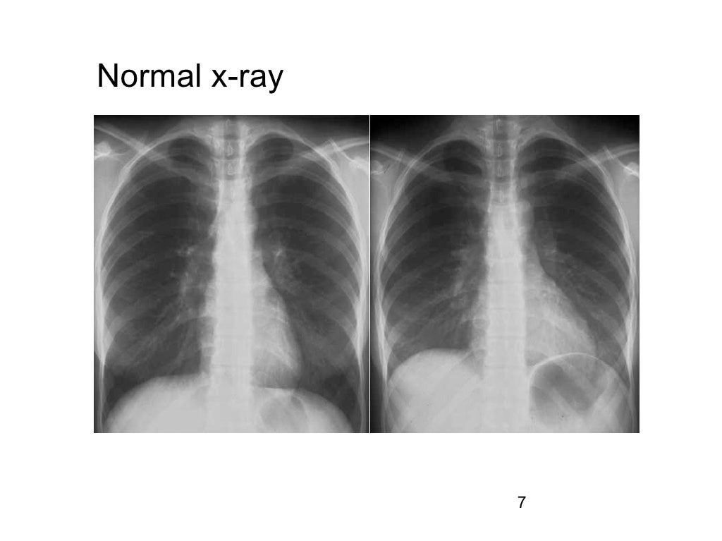 Amniotic Fluid Embolism