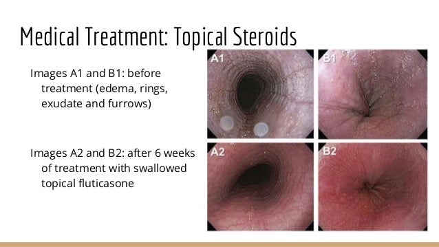 cancer nystatin swish esophageal thrush