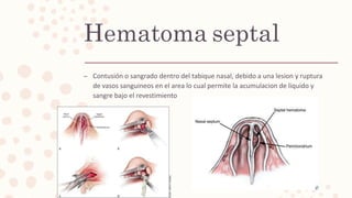 Afecciones del septum nasal  Slide 19