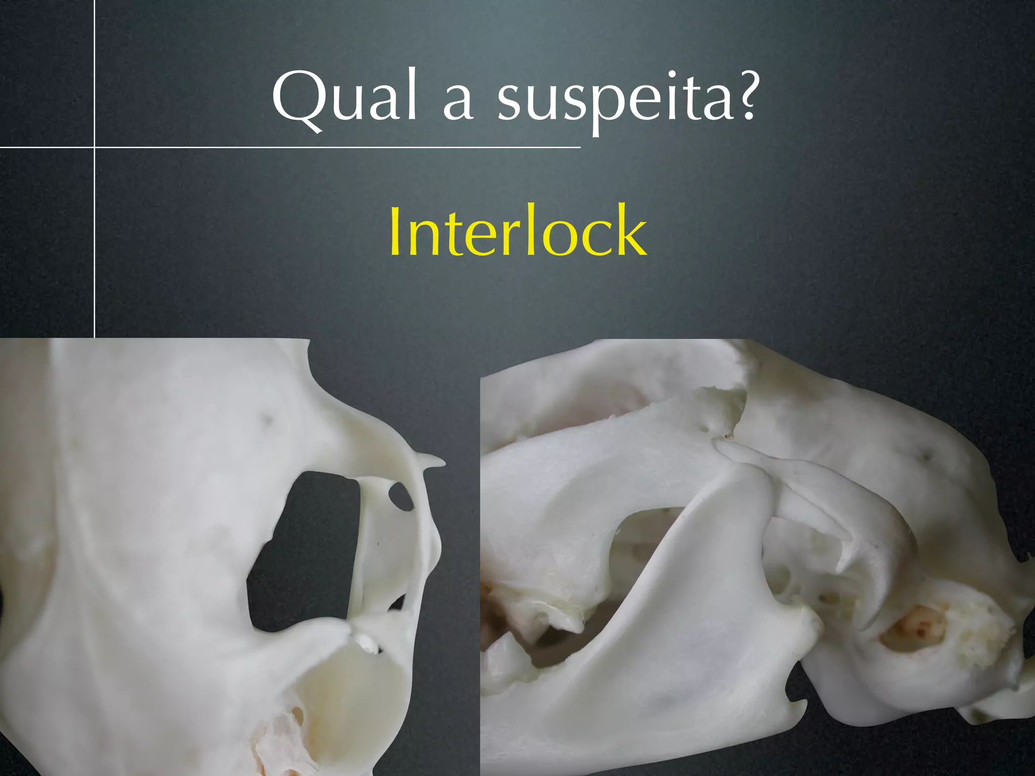 Qual a suspeita?
   Interlock
 
