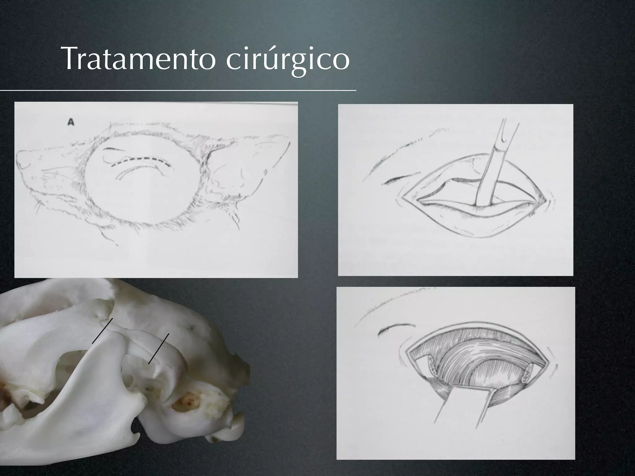 Tratamento cirúrgico
 