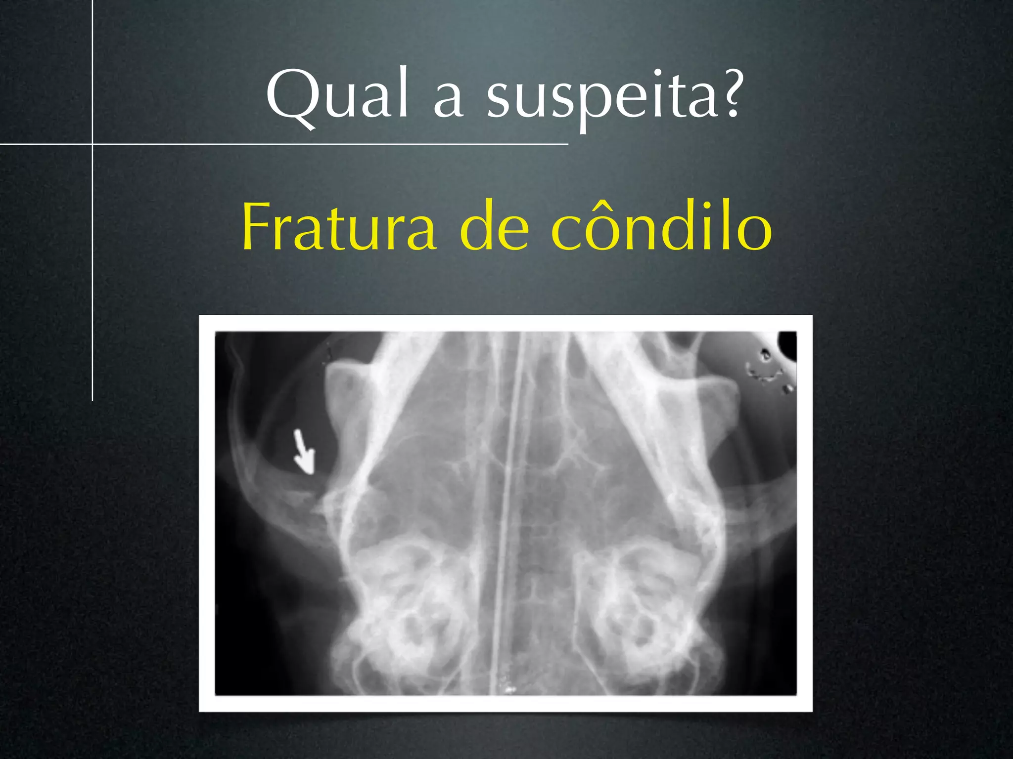 Qual a suspeita?
Fratura de côndilo
 