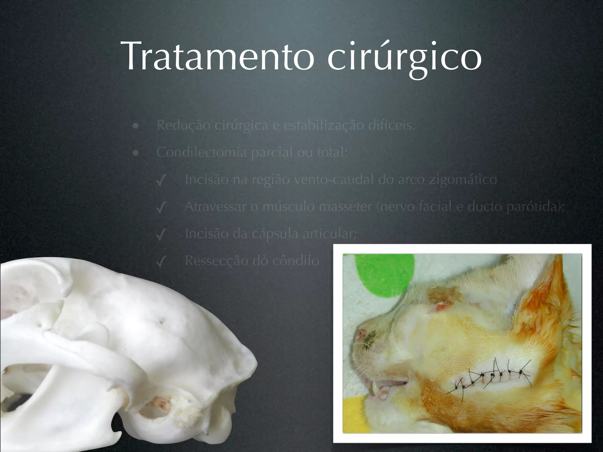 Tratamento cirúrgico
• Redução cirúrgica e estabilização difíceis.
• Condilectomia parcial ou total:
   ✓ Incisão na região vento-caudal do arco zigomático
   ✓ Atravessar o músculo masseter (nervo facial e ducto parótida);
   ✓ Incisão da cápsula articular;
   ✓ Ressecção do côndilo
 