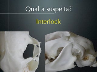 Qual a suspeita?
   Interlock
 