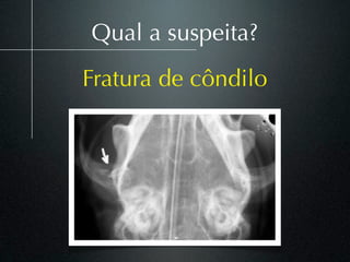 Qual a suspeita?
Fratura de côndilo
 