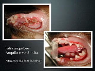 Falsa anquilose
Anquilose verdadeira

Alterações pós-condilectomia?
 