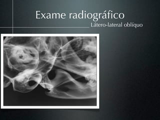 Exame radiográﬁco
          Látero-lateral oblíquo
 
