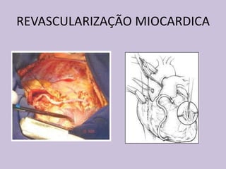 REVASCULARIZAÇÃO MIOCARDICA
 