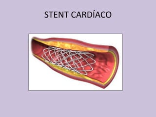 STENT CARDÍACO
 