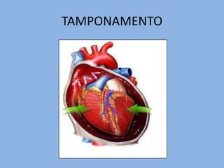 TAMPONAMENTO
 