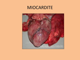 MIOCARDITE
 