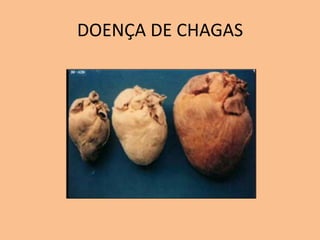 DOENÇA DE CHAGAS
 