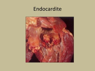 Endocardite
 